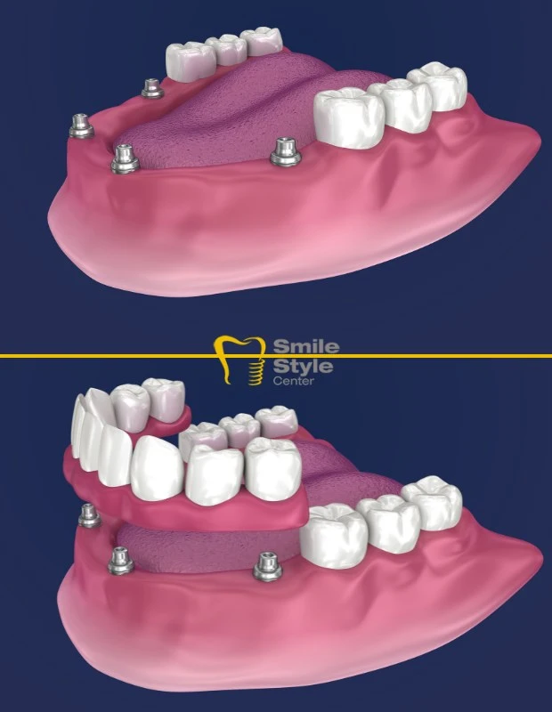 What is all-on-4? Turkey