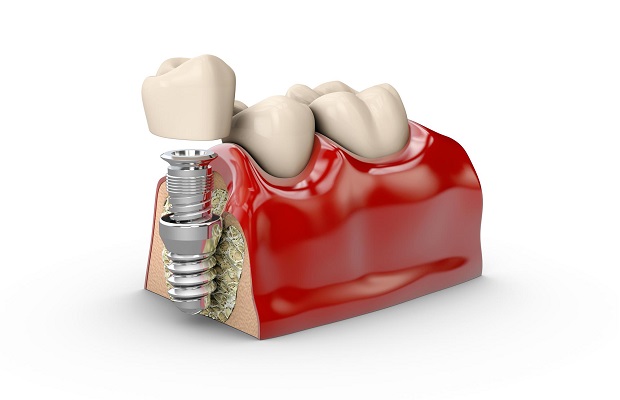 All on Four Dental Implant Treatment Turkey