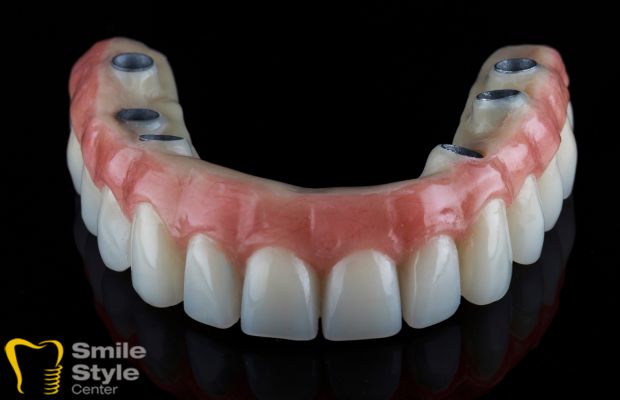 All on 6 Dental Implants Turkey