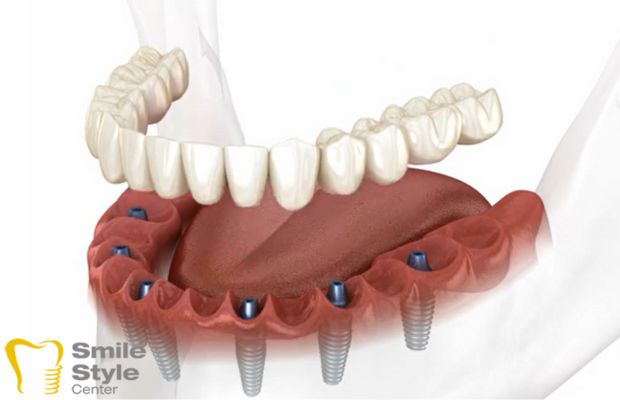 All on 6 Dental Implants Turkey