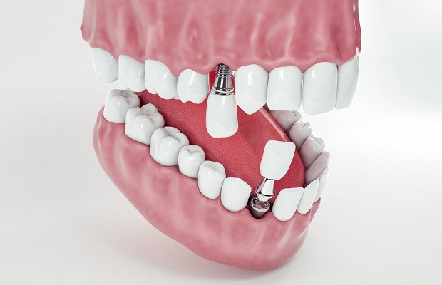 Dental Implants Turkey