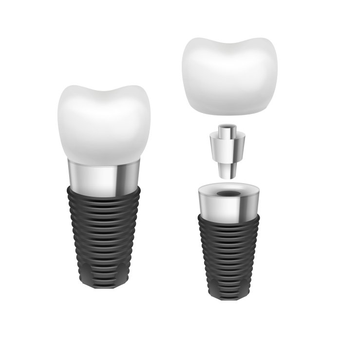 Dental Implants Turkey